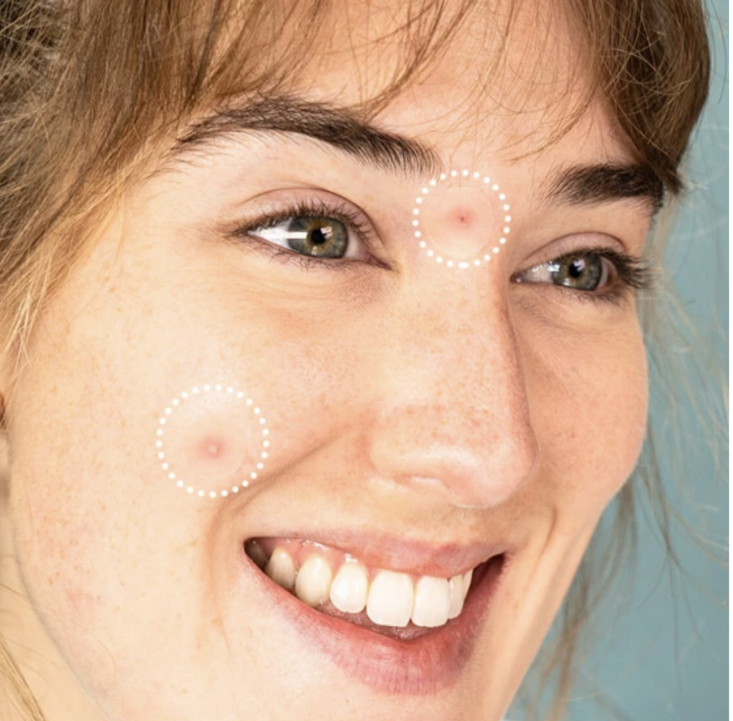 woman's face with circles around acne