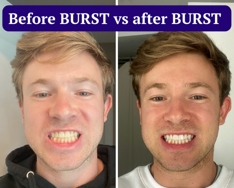 My Review of BURST’s Whitening Trays My Subscription Addiction