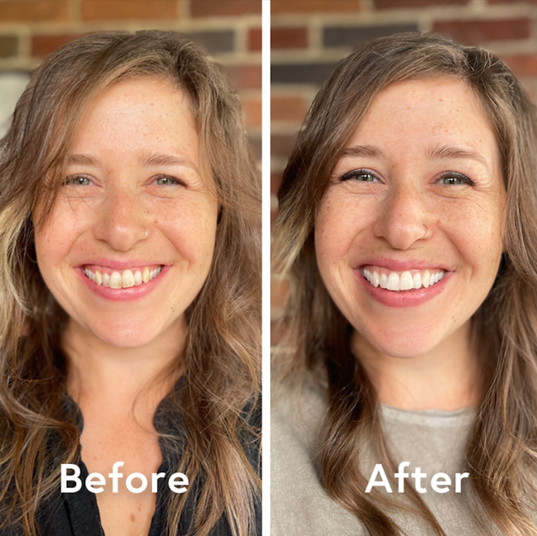 My Teeth Before and After Using Burst Whitening Trays Does it Really