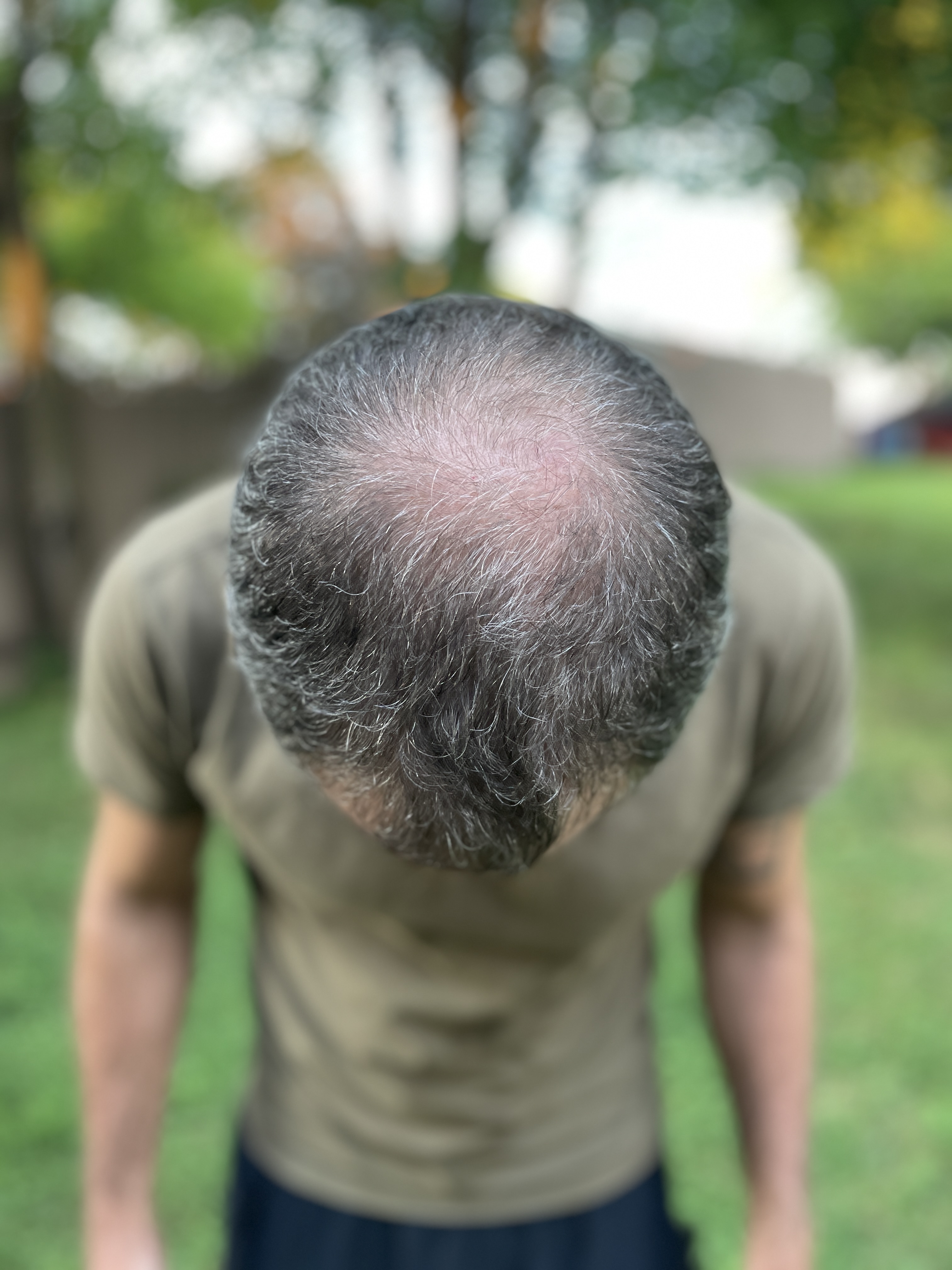 4 Wild Gimmicks People Have Tried In Order to Prevent Baldness (And What Actually Works)