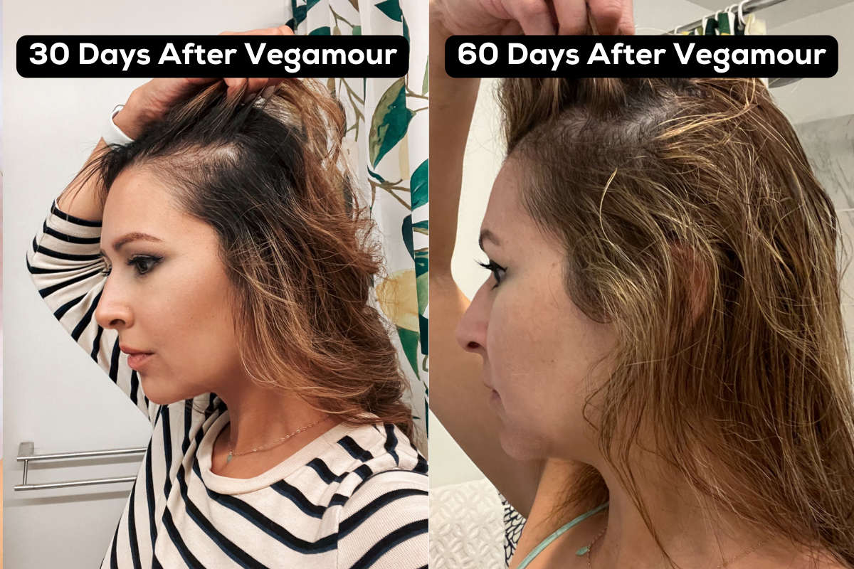 Want to know how I grew my hairline back? Take 20% off Vegamour's