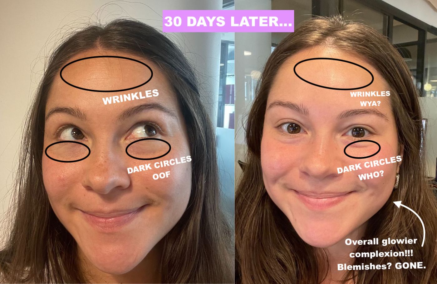 Preventive Skincare: How Solawave Gets Ahead of My Acne and Fine Lines Before They Even Appear
